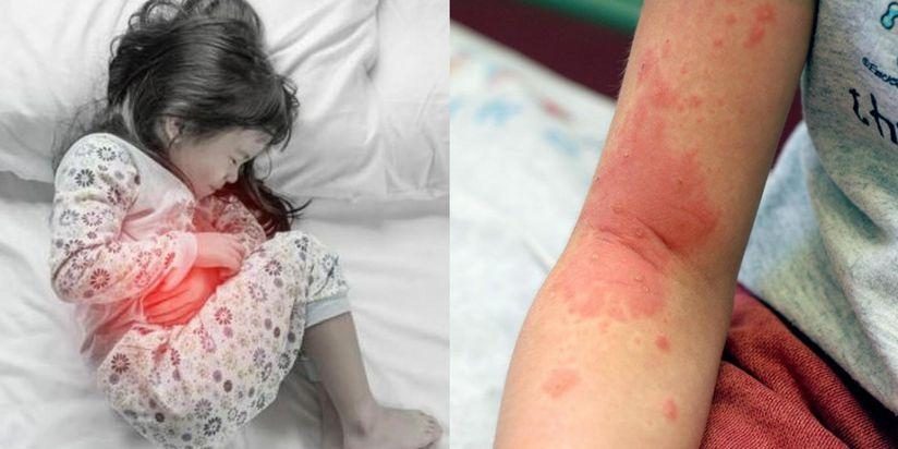 Signs and Symptoms of Coronavirus in Kids