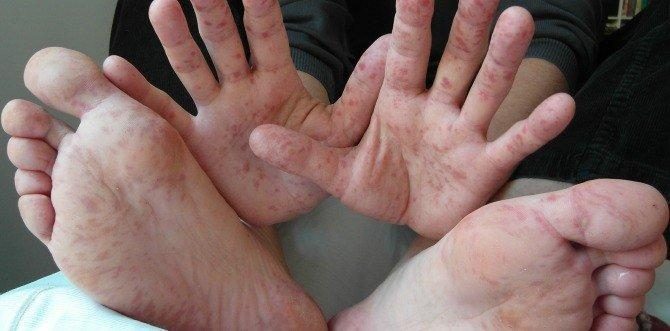 What all parents need to know about Hand Foot Mouth Disease